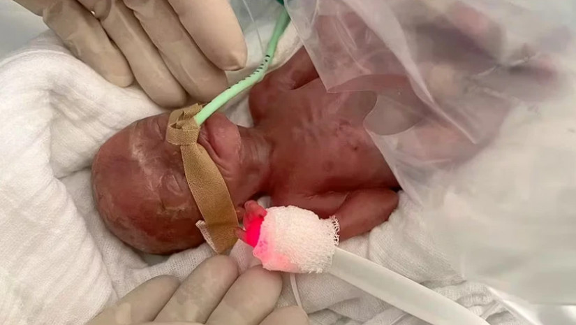 ბავშვი, რომელიც დაბადებისას 300 გრამს იწონიდა 