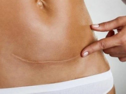 საკეისრო კვეთა